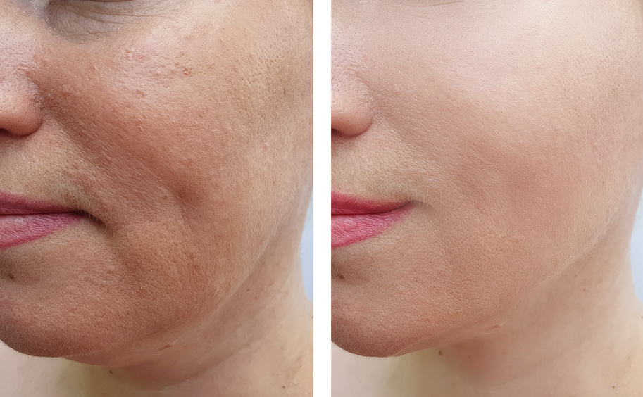 woman face wrinkles before and after correction